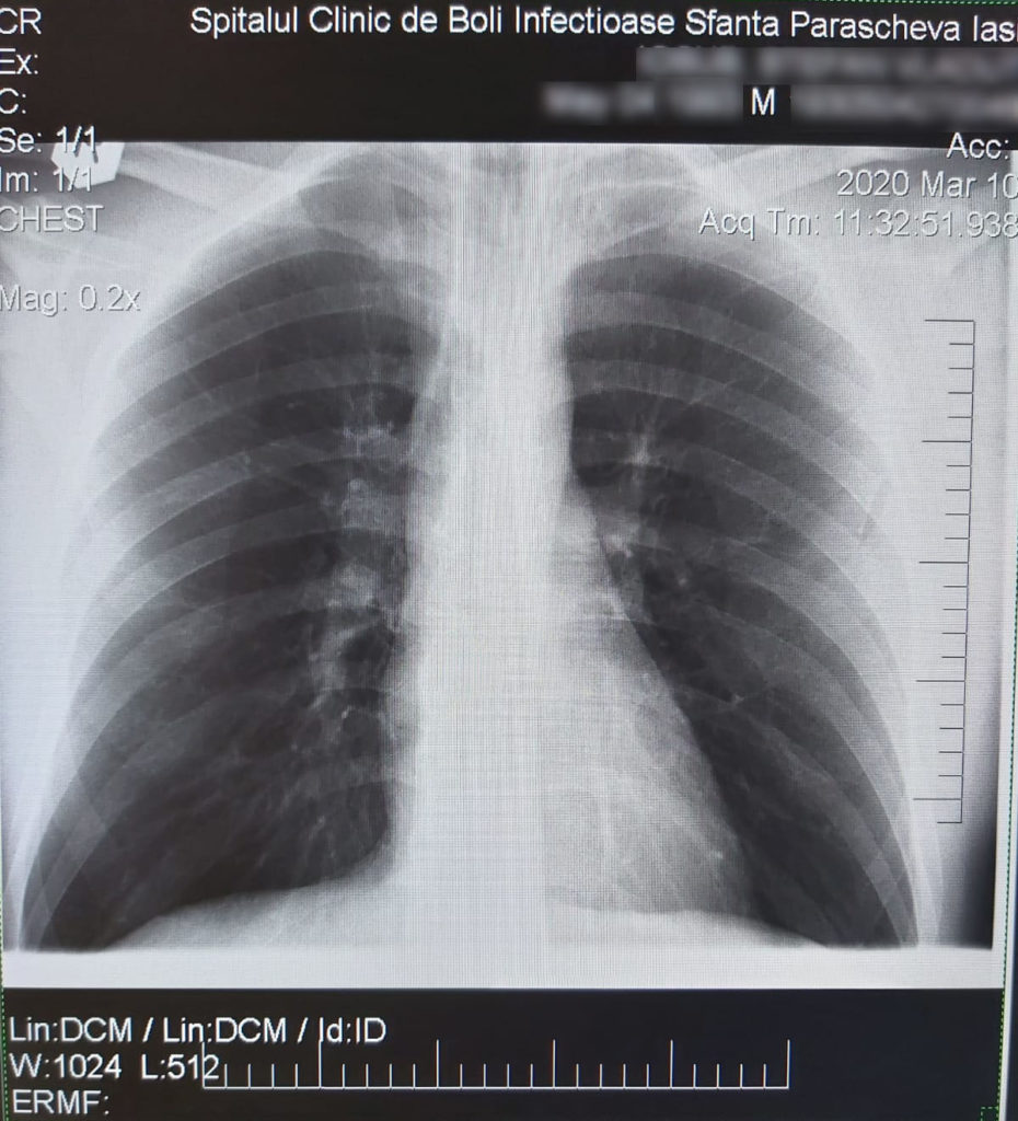 radiografie plamani cu imagini