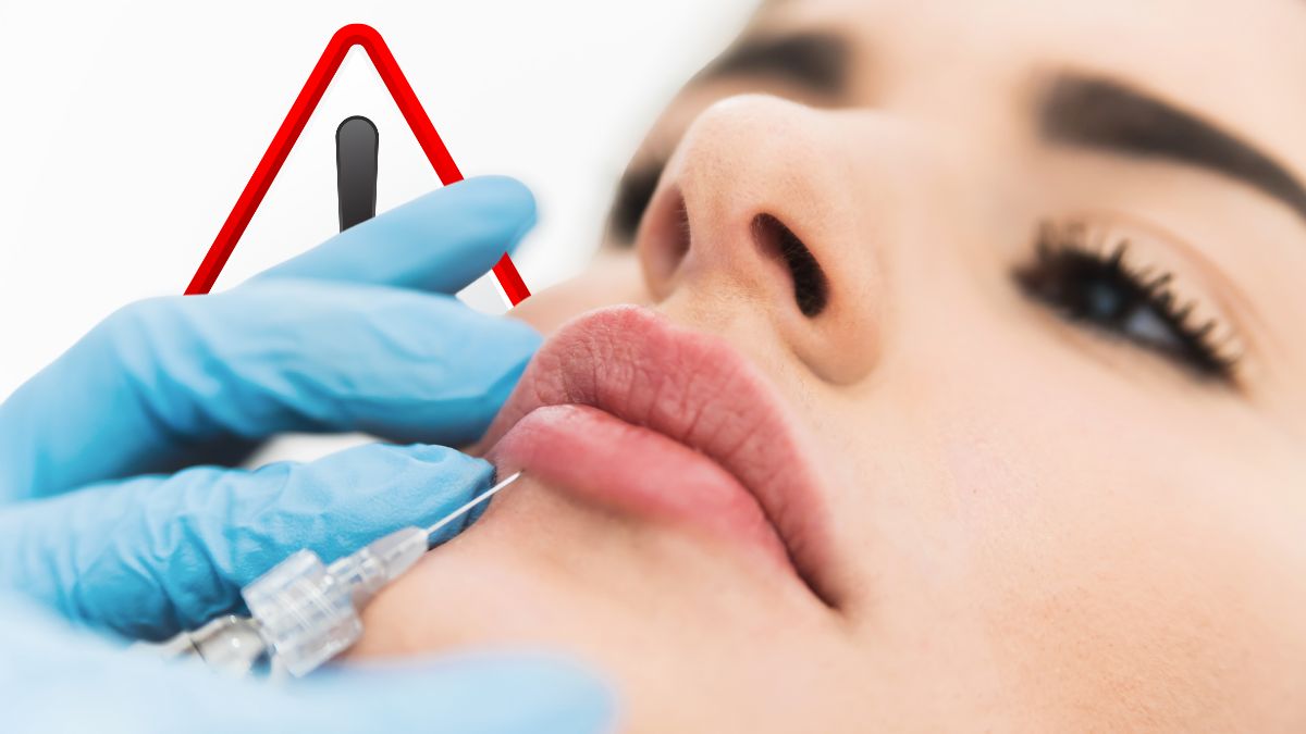 Procedurile pentru buze umflate nu sunt inofensive: Foto: Injectare acid hialuronic în buze