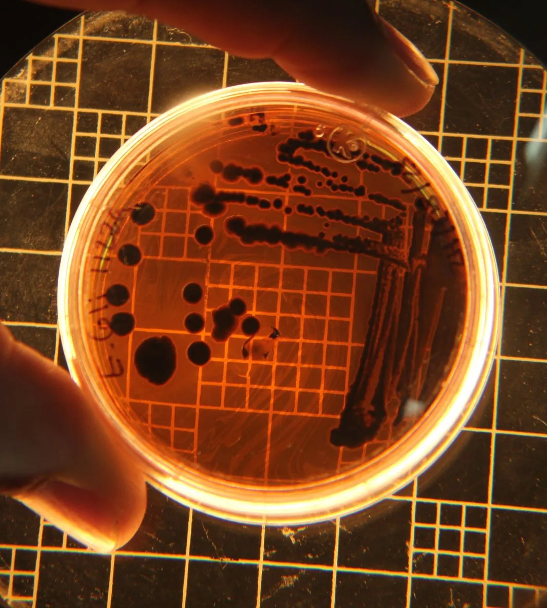Un adolescent de 17 ani luptă pentru viață sa după ce a fost infectat cu o „bacterie carnivoră”